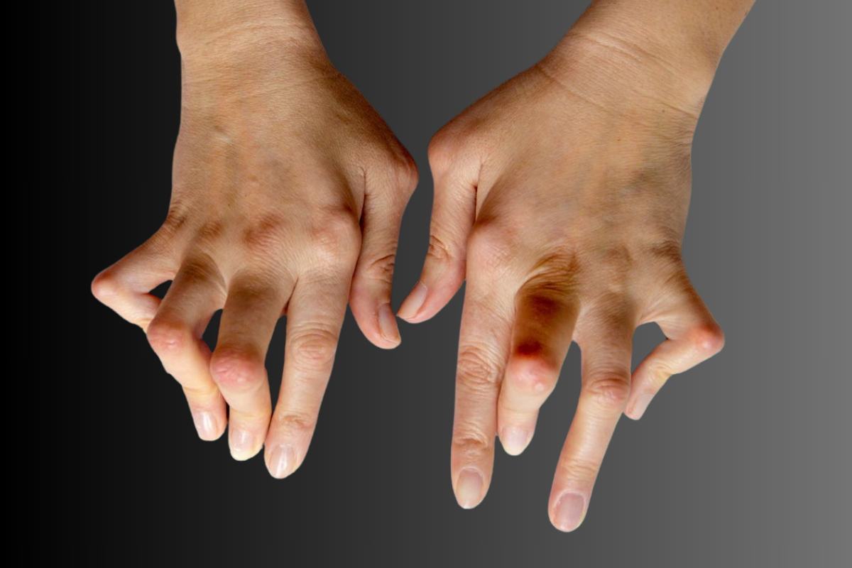 Rheumatoid Hand Deformity, રુમેટોઇડ હાથની વિકૃતિ
