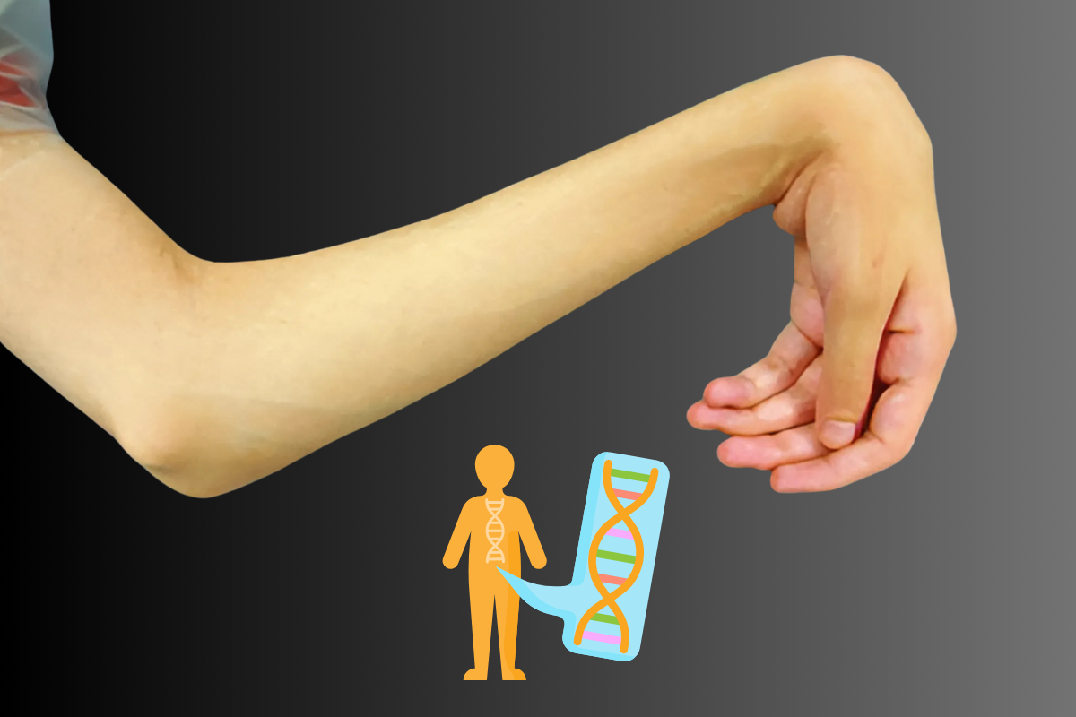 Is cerebral palsy genetic? See its effect on hand function