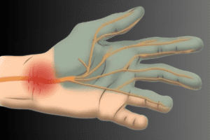 Carpal tunnel syndrome કાર્પલ ટનલ સિન્ડ્રોમ
