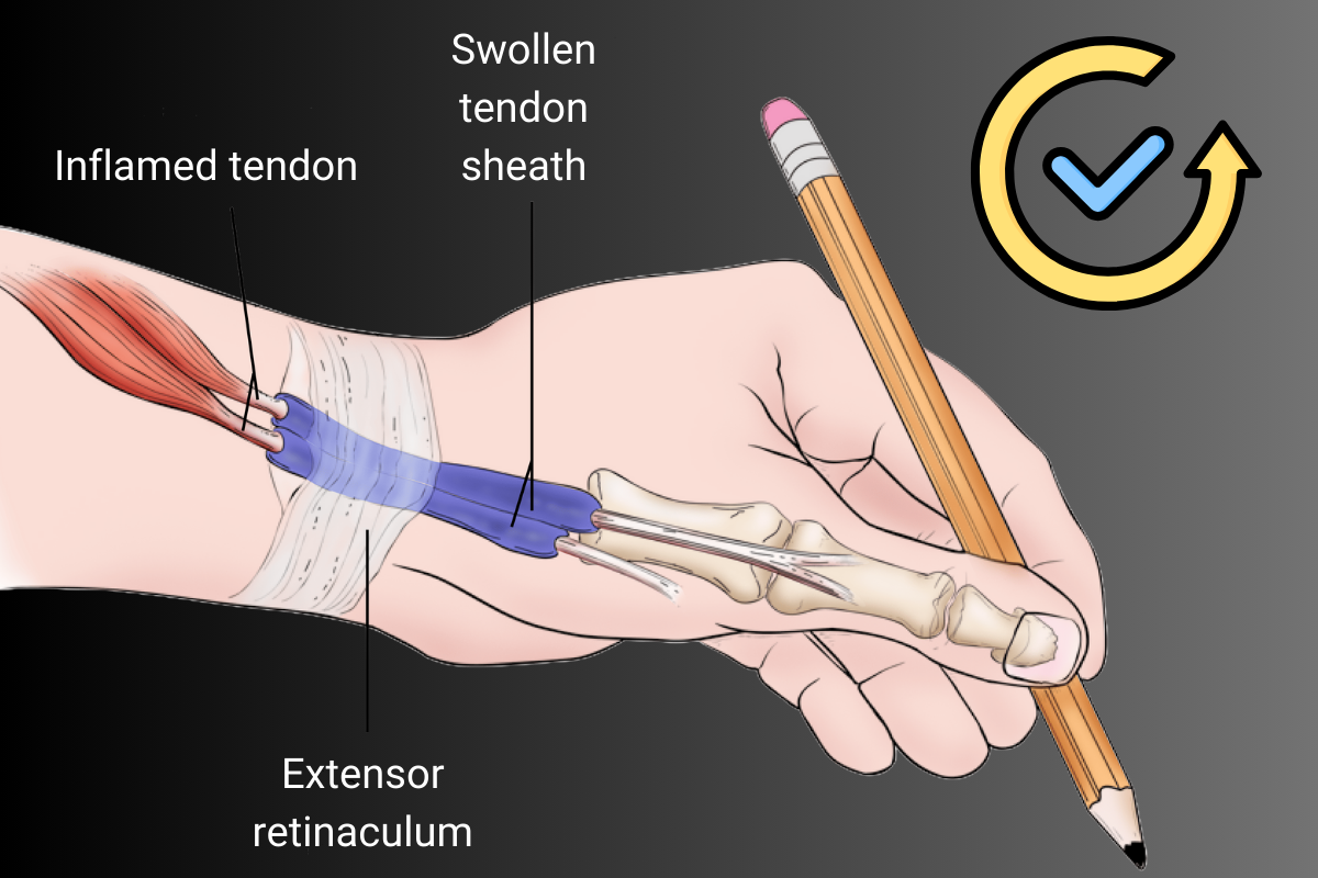 De Quervain’s tenosynovitis surgery recovery Timeline, tips & mistakes to avoid