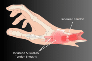De quervain's tenosynovitis