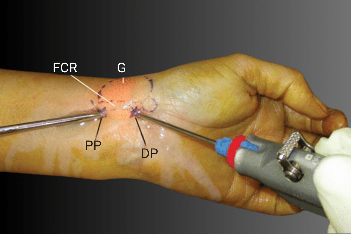 When to choose surgery for recurrent cysts