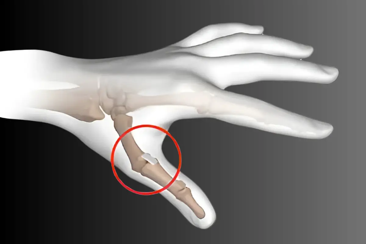 Torn ligament in hand