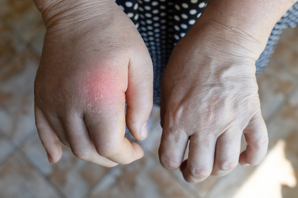 Can hand swelling be a sign of a serious condition