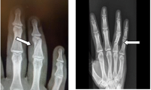 Middle and Proximal phalanx fractures