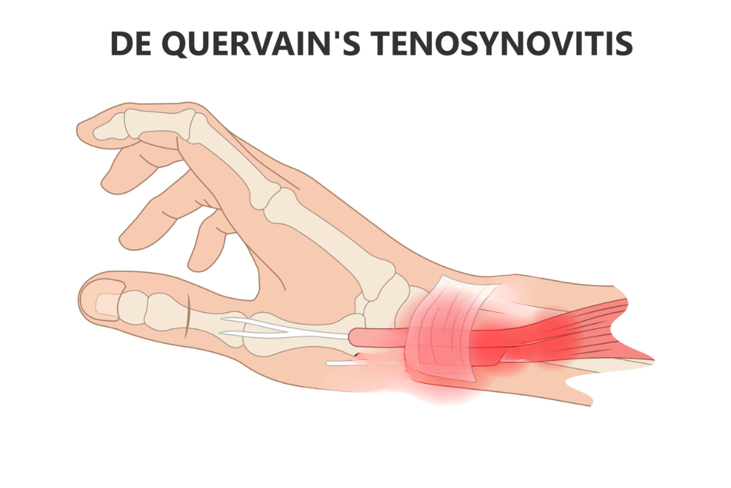 What to expect Before, During, and After De Quervain’s Release surgery?