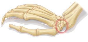 Scaphoid fracture