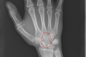 Carpal bone fractures (Wrist bones)