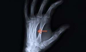 Metacarpal fractures (Palm Bones)