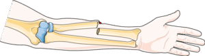 Open (Compound) fracture