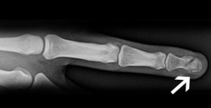Distal phalanx fracture (Tip of the Finger)