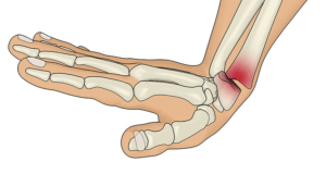 Smith’s fracture