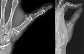 5. Intra-Articular fractures