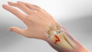 Distal radius fracture
