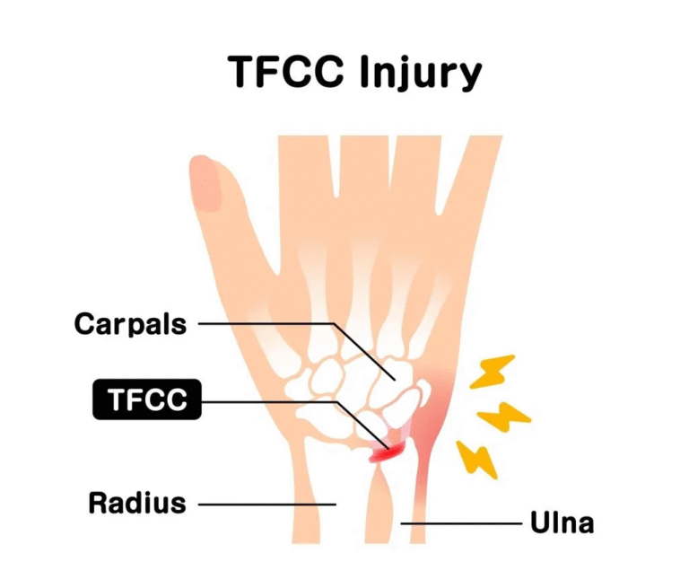 TFCC Injury (Triangular Fibrocartilage Complex)
