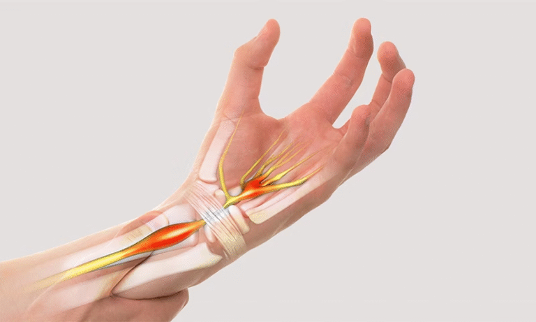 Carpal Tunnel Syndrome