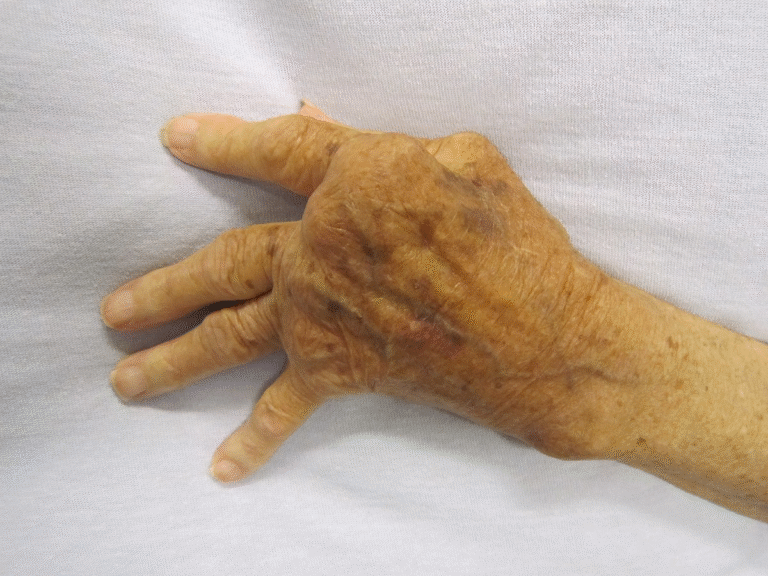 2. Arthritis (Osteoarthritis or Rheumatoid Arthritis)