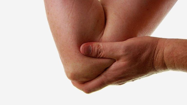 Cubital Tunnel Syndrome