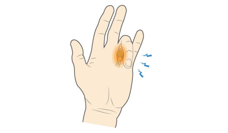 Trigger Finger (Stenosing Tenosynovitis)