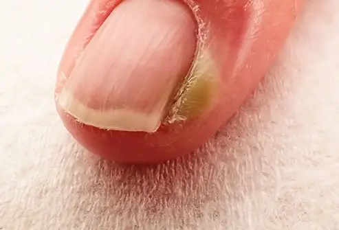 Infections (e.g., Felon or Paronychia)