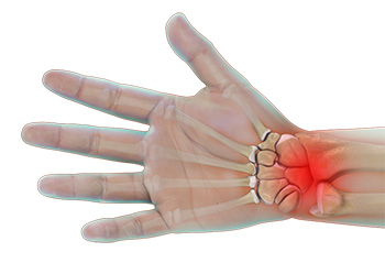 Wrist sprain