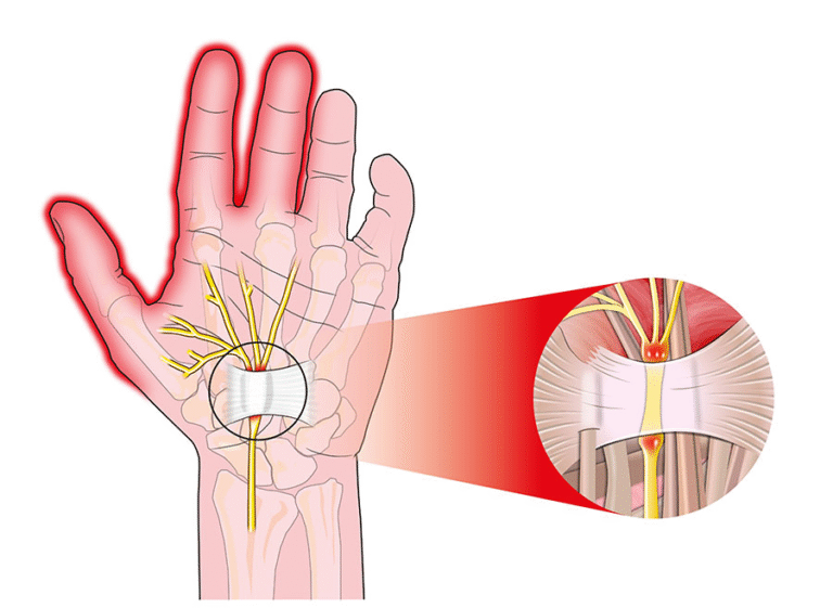 3. Carpal tunnel syndrome