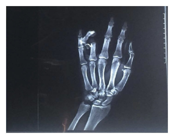 Contusions and Crush Injuries