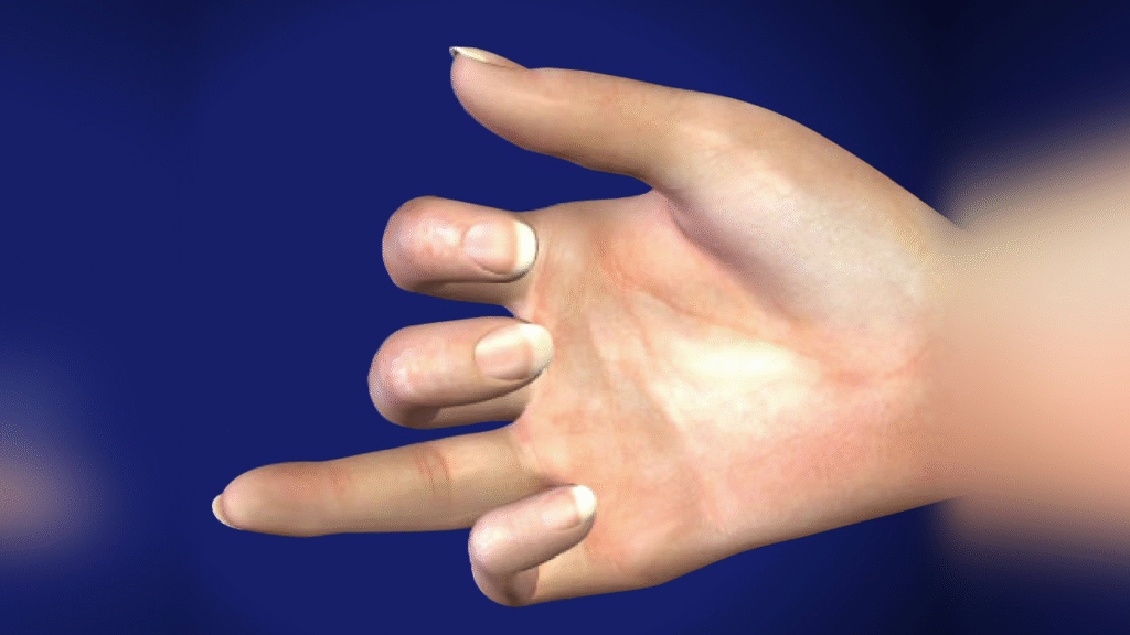 Tendon Injuries