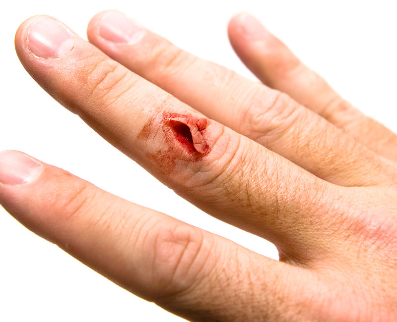 Cuts, Lacerations, and Puncture Wounds