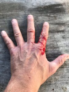 Cut Injury on Hand