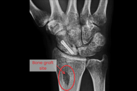 Bone grafting (For severe fractures) Bone grafting (For severe fractures)