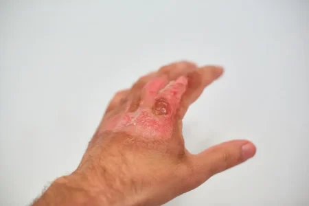 Burns & Chemical injuries