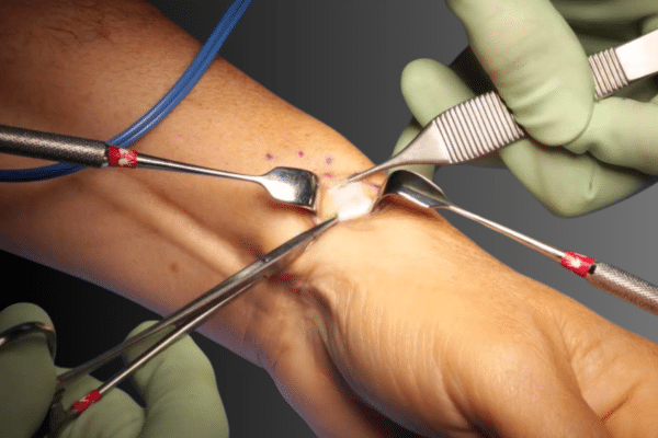 De quervain’s release surgery De quervain’s release surgery