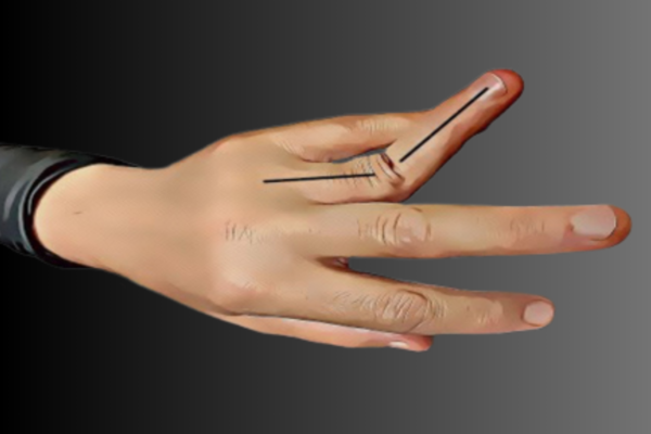Dislocations of fingers or thumb