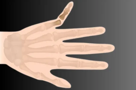 Dislocations