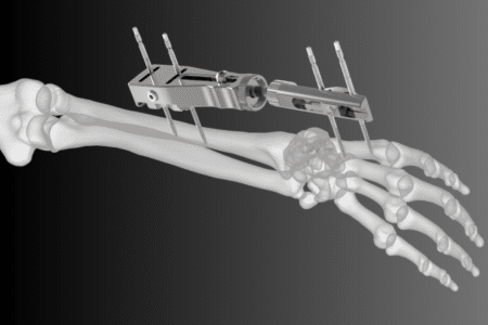 External fixation (For complex cases) External fixation (For complex cases)