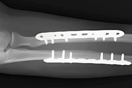 Fracture fixation (Internal fixation) Fracture fixation (Internal fixation)