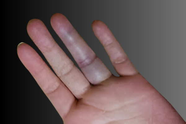 Jammed fingers (Sprained or Dislocated fingers)