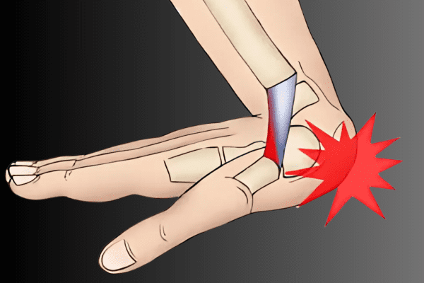 Joint sprains