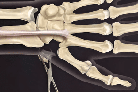 Ligament reconstruction Ligament reconstruction