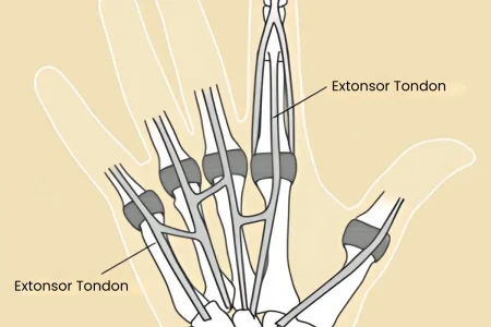 Primary tendon repair Primary tendon repair