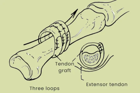 Reconstruction of pulley system