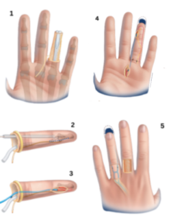 Regain strength & movement with precision hand replantation Regain strength & movement with precision hand replantation