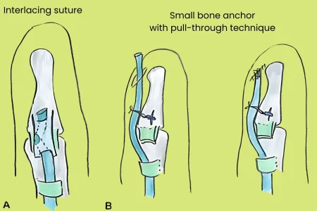 Tendon grafting