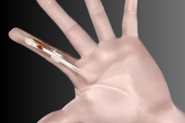 Tendon injuries (Extensor or Flexor tendons)