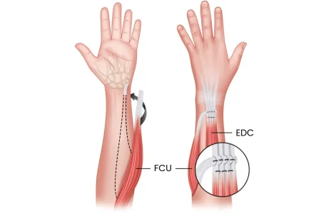 Tendon transfer
