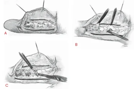 Tenolysis