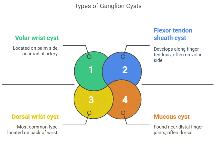 Types of ganglion cyst Types of ganglion cyst