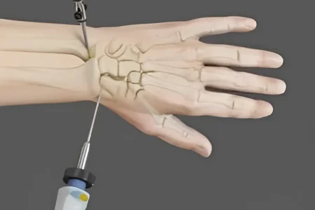 arthroscopy hand surgery arthroscopy hand surgery