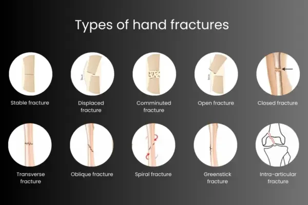 hand fracture pic types of hand fracture pic